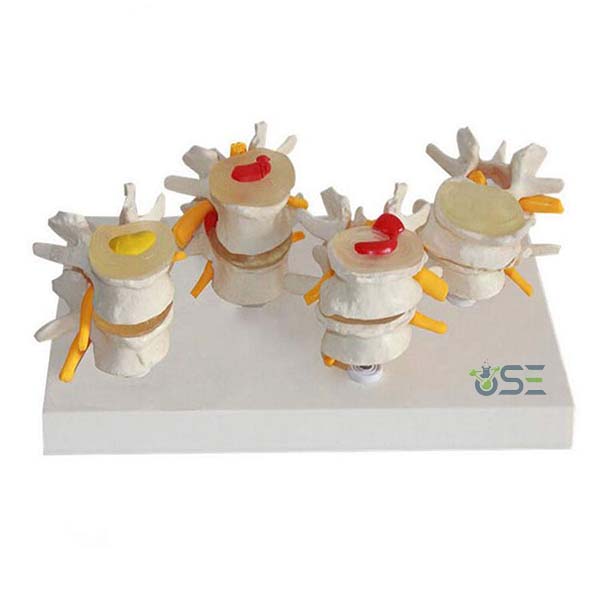 4 Stage Lumber Vertebrae Model